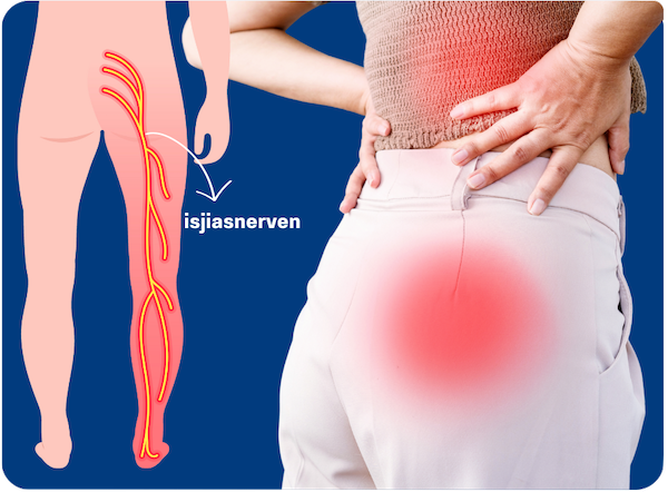 isjiasnerven