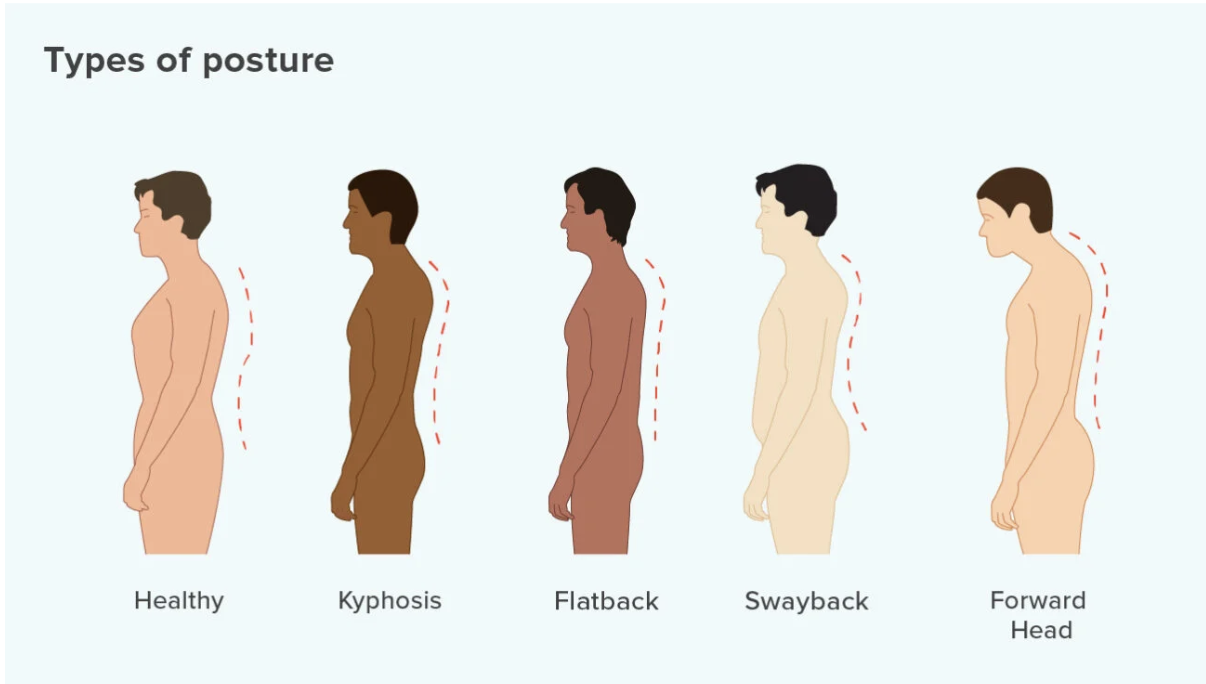 Illustration of five postures: healthy, kyphosis, flatback, swayback, forward head. Text labels each. Dotted lines indicate spinal curves.