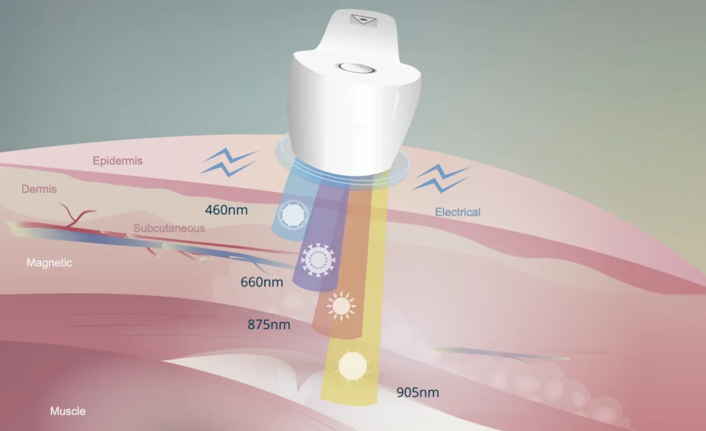 Laserterapi og MR5-laser hos Omegaklinikken