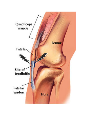 Illustrasjon av kneet som viser jumpers knee