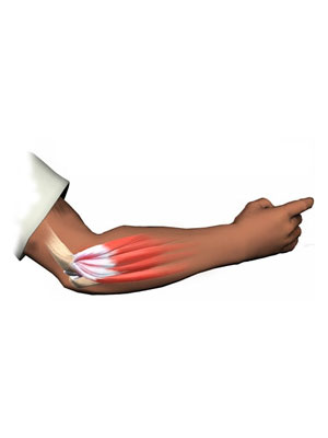 En illustrasjon av en arm som viser Lateral epikondylitt (tennisalbue)