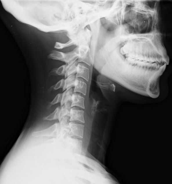 En xray som viser en person som har fått nakkesleng, whiplash