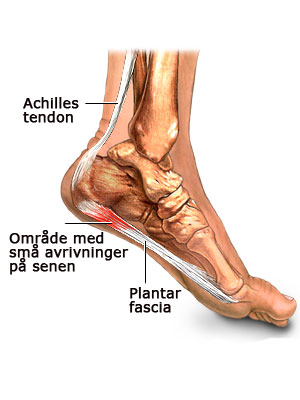 Illustrasjon av hvor Plantar Fasciitt befinner seg og hvordan det påvirker foten